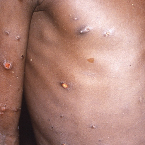 Cercetătorii africani avertizează asupra rapidității mutațiilor virusului mpox