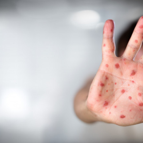 Copil de 2 ani diagnosticat cu tuse convulsivă şi rujeolă. Copilul nu a făcut niciun vaccin de când s-a născut