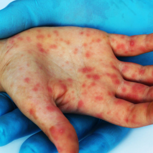 Nevaccinarea unui copil de 2 ani duce la decesul său din cauza rujeolei. Situația este gravă: peste 15.000 de infectări și 16 decese raportate în România.